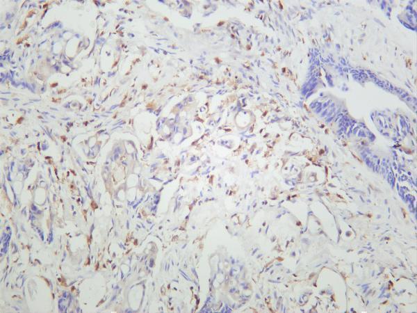 Human colon carcinoma was stained with anti-Caspase-1 rabbit antibody