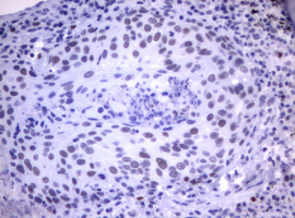Immunohistochemical staining of paraffin-embedded Carcinoma of Human lung tissue using anti-MDM2 mouse monoclonal antibody