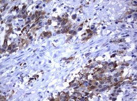 Immunohistochemical staining of paraffin-embedded Adenocarcinoma of Human ovary tissue using anti-MDM2 mouse monoclonal antibody
