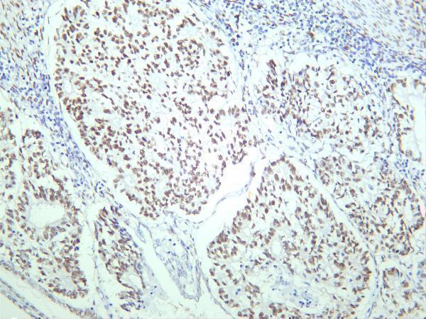 Human ovary carcinoma was stained with anti-Estrogen Receptor α rabbit antibody