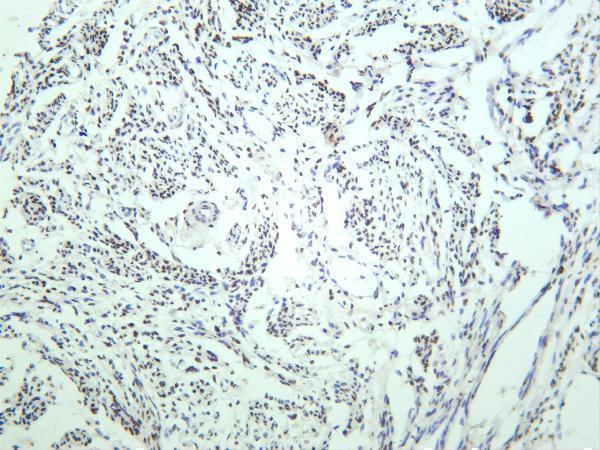 Human breast carcinoma was stained with anti-Estrogen Receptor α rabbit antibody