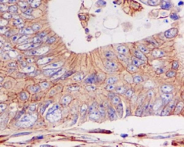 Immunohistochemical analysis of paraffin-embedded colon cancer, using pan Cadherin Antibody  