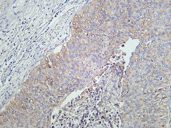 Human bladder carcinoma was stained with Anti-IGF1 Receptor rabbit antibody