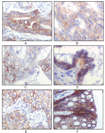 Immunohistochemistry analysis of paraffin-embedded human gastric adenocarcinoma (A), colon adenocarcinoma (B), endometrial carcinoma (uterus) (C), ovary adenocarcinoma (D), lung squamous cell carcinoma (E), stomach epithelium mucosae (F), showing membrane locali