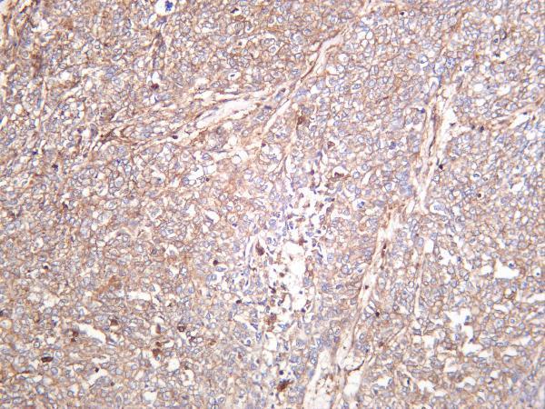 Human breast carcinoma was stained with anti-Smad4 rabbit antibody