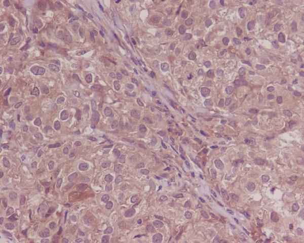 Immunohistochemical analysis of paraffin-embedded human breast cancer, using Smad4 Antibody