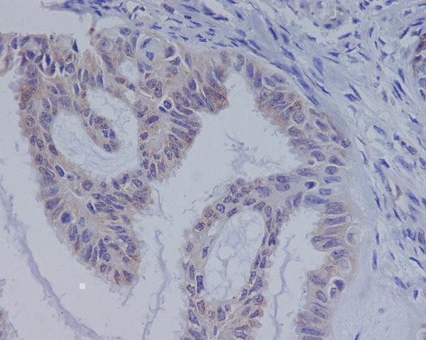 Immunohistochemical analysis of paraffin-embedded human ovarian cancer, using B Raf Antibody