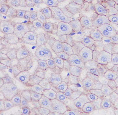 Immunohistochemical analysis of paraffin-embedded human liver carcinoma, using LDL Receptor Antibody 