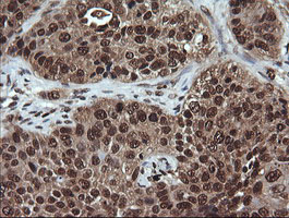 Immunohistochemical staining of paraffin-embedded Carcinoma of Human lung tissue using anti-VHL mouse monoclonal antibody