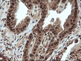 Immunohistochemical staining of paraffin-embedded Adenocarcinoma of Human ovary tissue using anti-VHL mouse monoclonal antibody