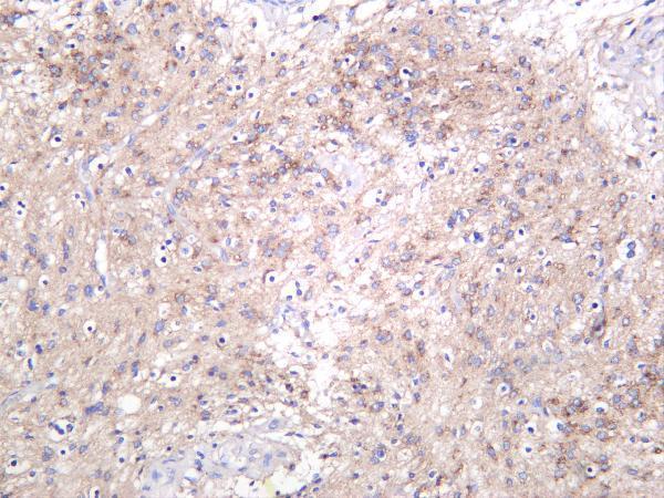 Human gliocytoma was stained with anti-Amyloid-β rabbit antibody