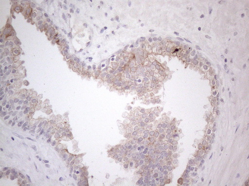 Immunohistochemical staining of paraffin-embedded Carcinoma of Human prostate tissue using anti-HGF mouse monoclonal antibody