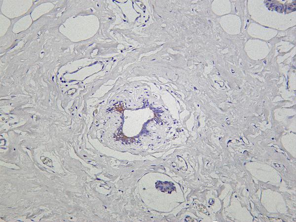 Human breast carcinoma was stained with Anti-FGFR1 rabbit antibody