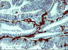 Immunohistochemical staining of paraffin-embedded Adenocarcinoma of Human endometrium tissue using anti-IL1B mouse monoclonal antibody
