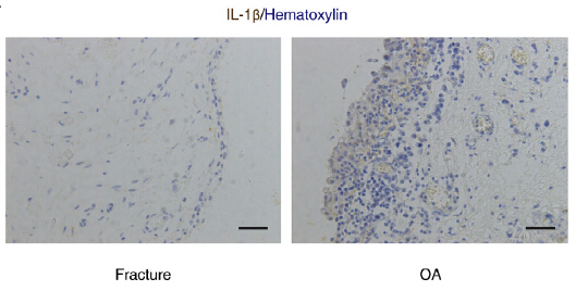 Figure from citation: Immunohistochemistry of IL1B protein level by using anti-IL1B antibody in synovial tissues from fracture and OA patients
