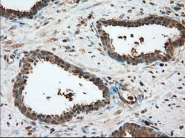 Immunohistochemical staining of paraffin-embedded Carcinoma of Human prostate tissue using anti-GPI mouse monoclonal antibody