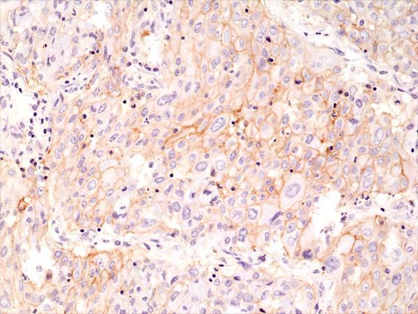 Immunohistochemical staining of formalin fixed
and paraffin embedded human lung cancer tissue
section using anti-PD-L1 rabbit monoclonal antibody
(Clone RM320) at a 1:1000 dilution