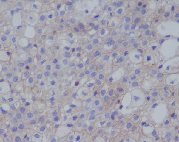 Immunohistochemical analysis of paraffin-embedded human thymoma, using PD-L1 (CD274) Antibody