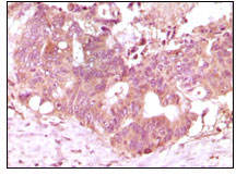 Immunohistochemistry analysis of paraffin-embedded human recturn adenocarcinoma tissue showing cytoplasmic localization with DAB staining using FGF-2 Monoclonal Antibody
