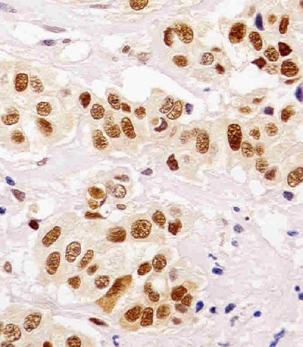 M00125-2 staining PCNA in human breast carcinoma tissue sections by Immunohistochemistry (IHC-P -paraformaldehyde-fixed, paraffin-embedded sections)