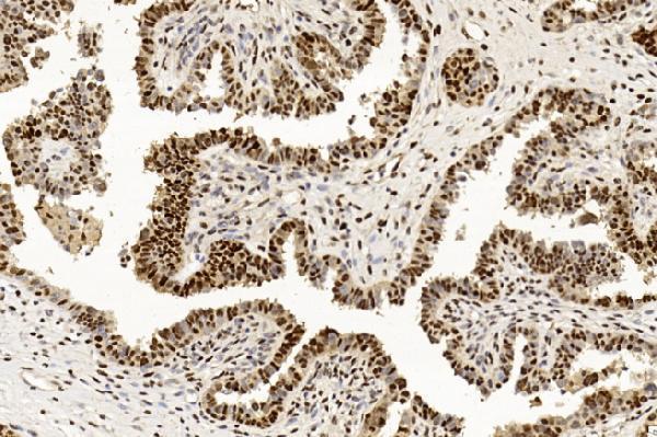 Immunohistochemical analysis of paraffin-embedded Human Ovarian cancer section using Pink1
