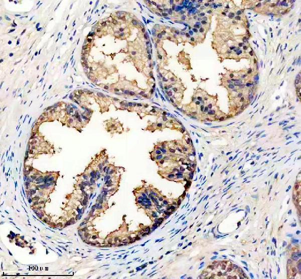 IHC analysis of IDH1 using anti-IDH1 antibody (M00129-2)