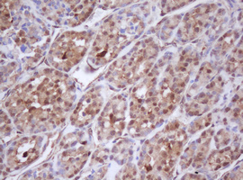 Immunohistochemical staining of paraffin-embedded Carcinoma of Human thyroid tissue using anti-IDH1 mouse monoclonal antibody