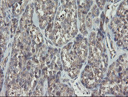 Immunohistochemical staining of paraffin-embedded Carcinoma of Human thyroid tissue using anti-RIPK1 mouse monoclonal antibody