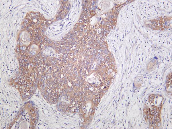 Human cervical carcinoma was stained with anti-RIP rabbit antibody