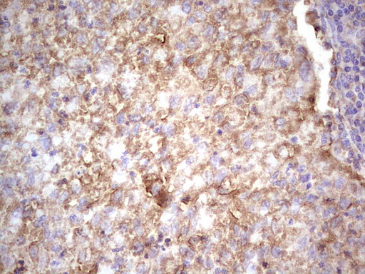 Immunohistochemical staining of paraffin-embedded Carcinoma of Human lung tissue using anti-IGF1 mouse monoclonal antibody