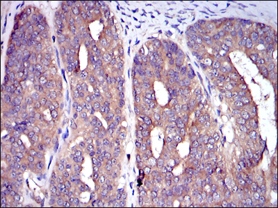 Immunohistochemistry analysis of paraffin-embedded ovarian cancer tissues with DAB staining using Cbl Monoclonal Antibody