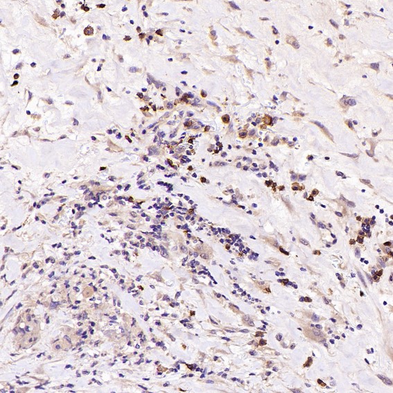 Immunohistochemical analysis of paraffin-embedded Human Hodgkins lymphoma, using the Antibody at 1:1000 dilution. Immunohistochemical analysis of paraffin-embedded Human Hodgkins lymphoma, using the Antibody at 1:1000 dilution.