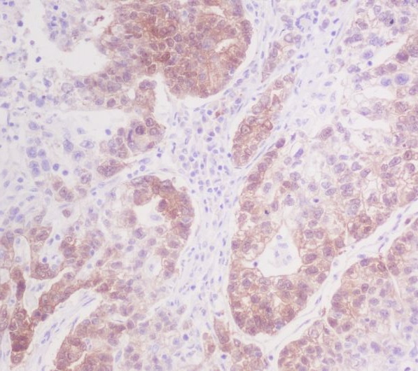 Immunohistochemical analysis of paraffin-embedded human stomach cancer, using CDK4 Antibody