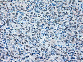 Immunohistochemical staining of paraffin-embedded Carcinoma of thyroid tissue using anti-IRF3mouse monoclonal antibody