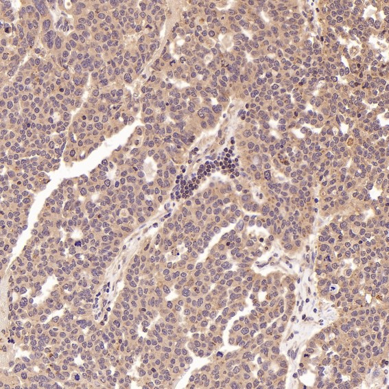 Immunohistochemical analysis of paraffin-embedded Human ovarian cancer, using the Antibody at 1:50 dilution