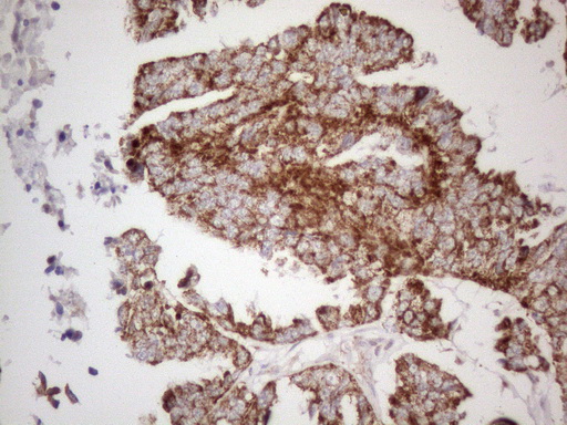 Immunohistochemical staining of paraffin-embedded Adenocarcinoma of Human ovary tissue using anti-MAVS mouse monoclonal antibody