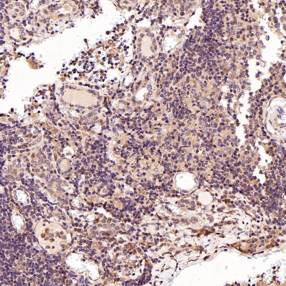 Immunohistochemical analysis of paraffin-embedded Human thyroid cancer, using the Antibody at 1:50 dilution