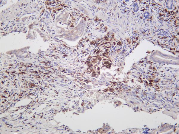 Human colon carcinoma was stained with anti-Bcl-XL rabbit antibody
