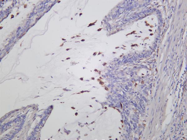 Human colon carcinoma was stained with anti-Bcl-XL rabbit antibody