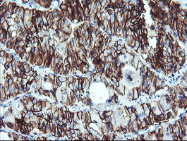 Immunohistochemical staining of paraffin-embedded Carcinoma of Human thyroid tissue using anti-NCAM1 mouse monoclonal antibody