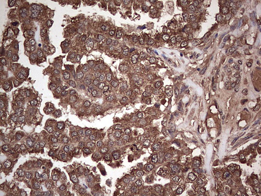 Immunohistochemical staining of paraffin-embedded Adenocarcinoma of Human ovary tissue using anti-DICER1 mouse monoclonal antibody