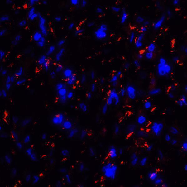 Immunofluorescence of CD80 in human stomach carcinoma tissue with CD80 antibody at 20 μg/mL