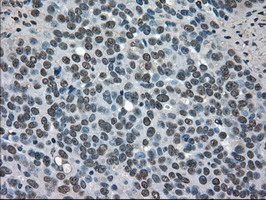 Immunohistochemical staining of paraffin-embedded Adenocarcinoma of Human ovary tissue using anti-SOD1 mouse monoclonal antibody