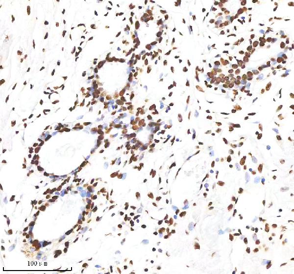 Figure 2. IHC analysis of H2AFX using anti-H2AFX antibody (M00241-1). H2AFX was detected in a paraffin-embedded section of human breast hyperplasia tissue. Heat mediated antigen retrieval was performed in EDTA buffer (pH 8.0, epitope retrieval solution). The tissue section was blocked with 10% goat serum. The tissue section was then incubated with 1:200 rabbit anti-H2AFX Antibody (M00241-1) overnight at 4°C. Peroxidase Conjugated Goat Anti-rabbit IgG was used as secondary antibody and incubated for 30 minutes at 37°C. The tissue section was developed using HRP Conjugated Rabbit IgG Super Vision Assay Kit (Catalog # SV0002) with DAB as the chromogen. Figure 2. IHC analysis of H2AFX using anti-H2AFX antibody (M00241-1). H2AFX was detected in a paraffin-embedded section of human breast hyperplasia tissue. Heat mediated antigen retrieval was performed in EDTA buffer (pH 8.0, epitope retrieval solution). The tissue section was blocked with 10% goat serum. The tissue section was then incubated with 1:200 rabbit anti-H2AFX Antibody (M00241-1) overnight at 4°C. Peroxidase Conjugated Goat Anti-rabbit IgG was used as secondary antibody and incubated for 30 minutes at 37°C. The tissue section was developed using HRP Conjugated Rabbit IgG Super Vision Assay Kit (Catalog # SV0002) with DAB as the chromogen.