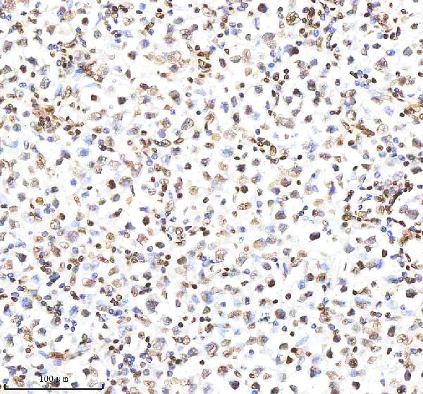 Figure 3. IHC analysis of H2AFX using anti-H2AFX antibody (M00241-1). H2AFX was detected in a paraffin-embedded section of human testis cancer tissue. Heat mediated antigen retrieval was performed in EDTA buffer (pH 8.0, epitope retrieval solution). The tissue section was blocked with 10% goat serum. The tissue section was then incubated with 1:200 rabbit anti-H2AFX Antibody (M00241-1) overnight at 4°C. Peroxidase Conjugated Goat Anti-rabbit IgG was used as secondary antibody and incubated for 30 minutes at 37°C. The tissue section was developed using HRP Conjugated Rabbit IgG Super Vision Assay Kit (Catalog # SV0002) with DAB as the chromogen. Figure 3. IHC analysis of H2AFX using anti-H2AFX antibody (M00241-1). H2AFX was detected in a paraffin-embedded section of human testis cancer tissue. Heat mediated antigen retrieval was performed in EDTA buffer (pH 8.0, epitope retrieval solution). The tissue section was blocked with 10% goat serum. The tissue section was then incubated with 1:200 rabbit anti-H2AFX Antibody (M00241-1) overnight at 4°C. Peroxidase Conjugated Goat Anti-rabbit IgG was used as secondary antibody and incubated for 30 minutes at 37°C. The tissue section was developed using HRP Conjugated Rabbit IgG Super Vision Assay Kit (Catalog # SV0002) with DAB as the chromogen.