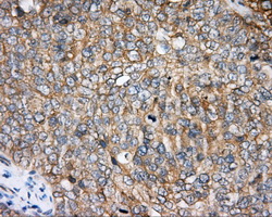 Immunohistochemical staining of paraffin-embedded Adenocarcinoma of ovary tissue using anti-BTK mouse monoclonal antibody