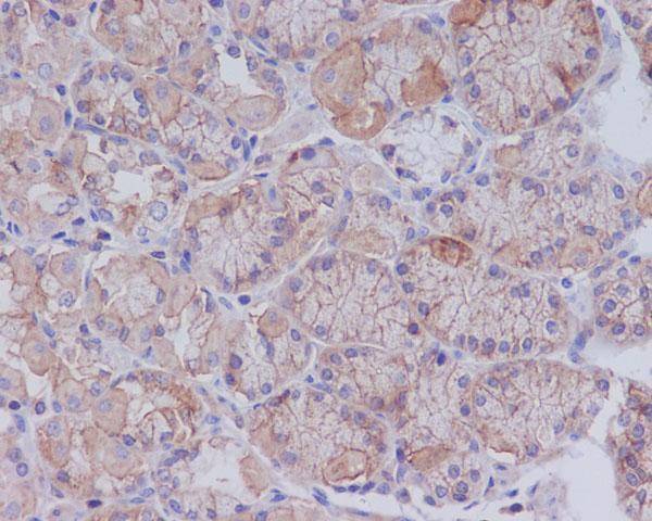 Immunohistochemical analysis of paraffin-embedded human stomach cancer, using CD147 Antibody