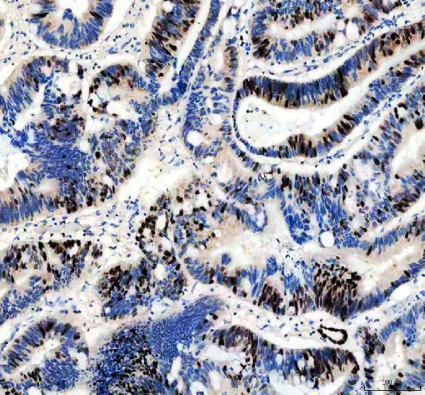 IHC analysis of Ki67/MKI67 using anti-Ki67/MKI67 antibody (M00254-11)