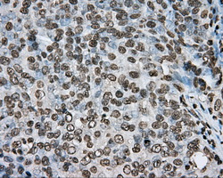 Immunohistochemical staining of paraffin-embedded Adenocarcinoma of ovary tissue N93ing anti-ARNTL mouse monoclonal antibody