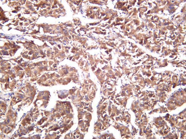 Human hepatocellular carcinoma was stained with anti-TBK1 rabbit antibody